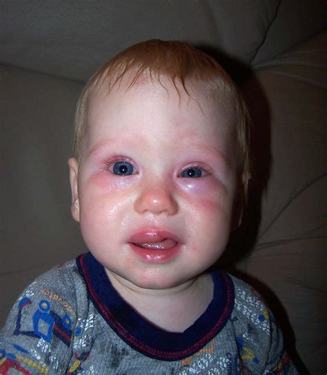 List 105+ Pictures Allergic Reaction On Face Pictures Updated