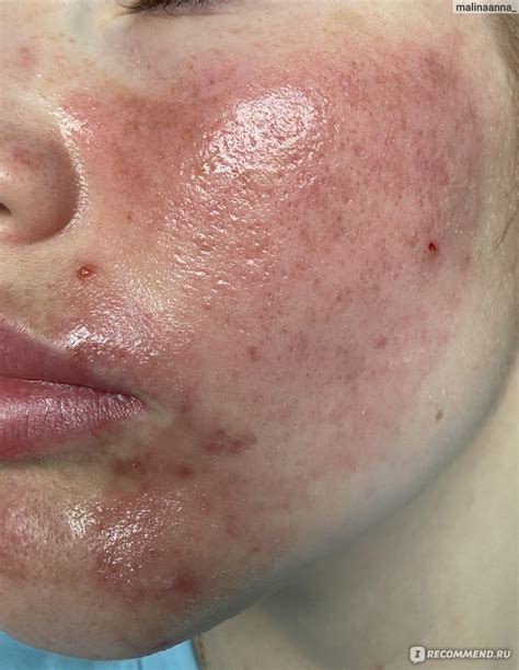 Холодная плазма - «Есть результат после первой и второй процедуры👍 ...