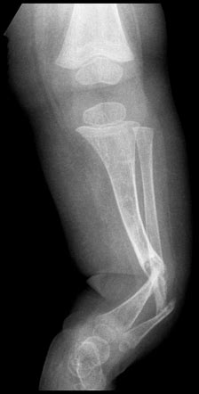 Neurofibromatosis Type 1 Musculoskeletal Manifestations Radiology