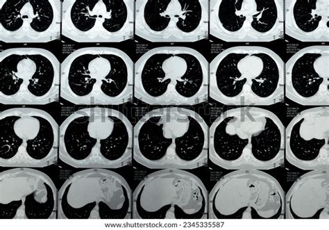 Heart Structure Ct Scan Photos And Images Shutterstock