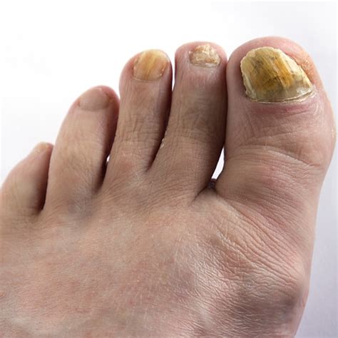 Fungal Infection Glasgow Happy Soles Home Visit Service