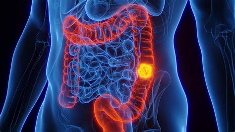 New Blood Test Detects Early Stage Bowel Cancer Effectively News