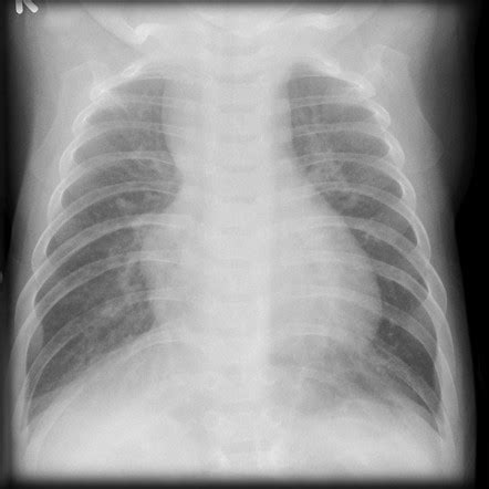 Atrioventricular Septal Defect Radiology Reference Article