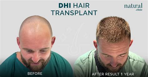 Unshaven Hair Transplant Dhi Hair Transplant In Turkey Natural Clinic