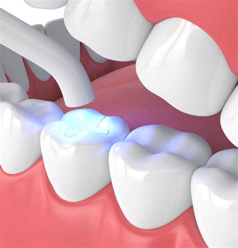 Best Composite Materials Dental Zyphoria