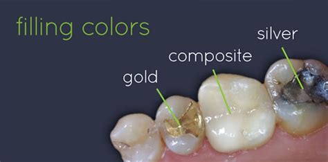 Composites The Most Versatile Tooth Coloured Filling Material For