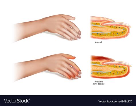 Frostbite first degree skin injury that occurs Vector Image