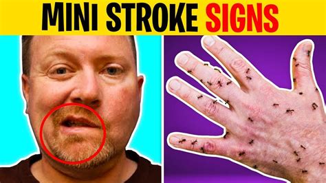 9 Signs Of Mini Strokes In Elderly Transient Ischemic Attack Youtube