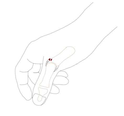 sprained thumb   step guide  patients dr nick golinvaux