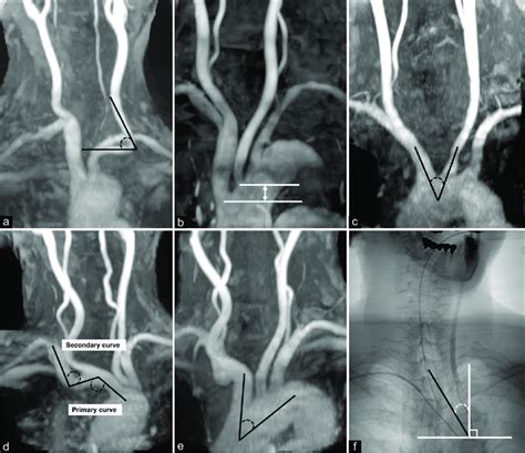 Definitions Of Anatomical Features A Common Carotid Artery Cca