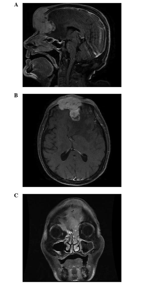 Ethmoid Sinus Malignancy