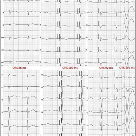 Twelve Lead Electrocardiogram Ecg At Baseline And Following Bvp Hbp