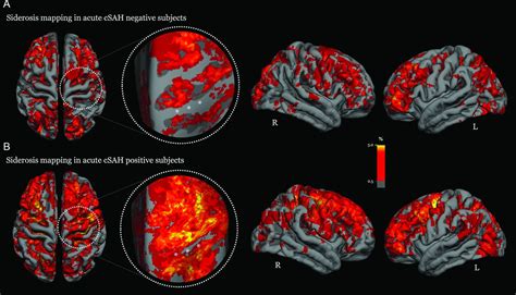 Acute Convexity Subarachnoid Haemorrhage And Cortical Superficial