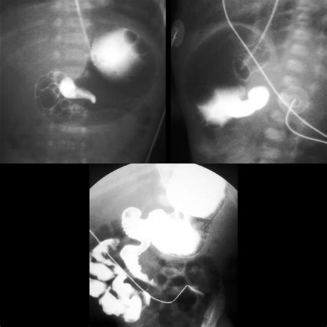 Imaging Intestinal Malrotation 7