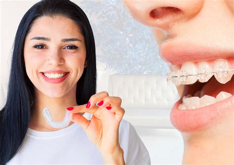 What Are Clear Braces Dental On The Banks