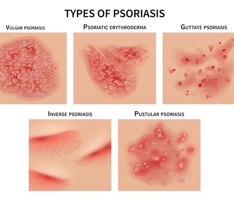 Psoriasi Cosè Come Inizia E Come Si Cura