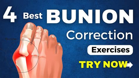 Bunion Pain Relief And Correction Exercises Try These Effective