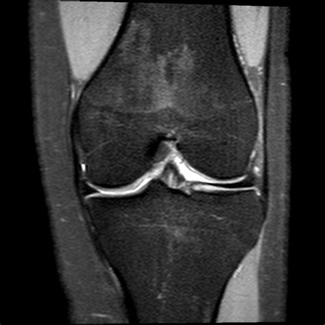 Normal Knee Mri Scan