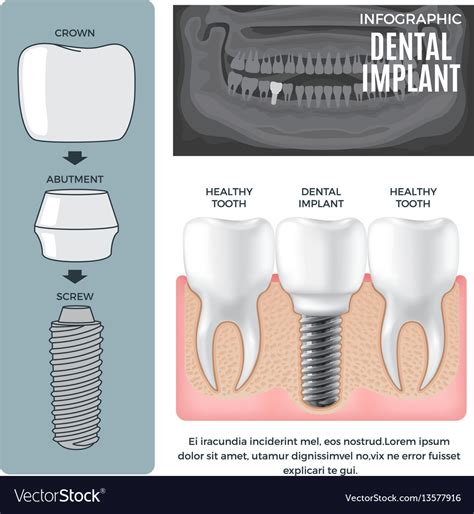 Infographic Dental Implant Structure Info Poster Vector Image