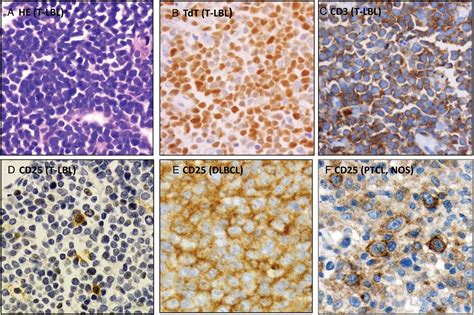 Serum Level Of Soluble Interleukin 2 Receptor Correlates With Cd25