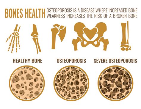 A COMPREHENSIVE GUIDE TO UNDERSTANDING OSTEOPOROSIS Add More To Life