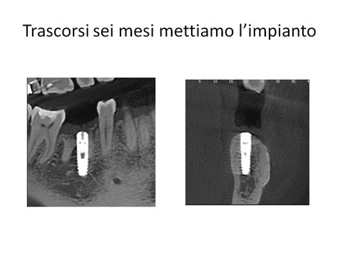 Riabilitazione In Seguito A Frattura Dentale Dentista Roma