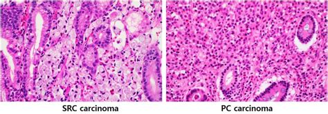 Signet Ring Cell Src Carcinoma And Poorly Cohesive Pc Carcinoma