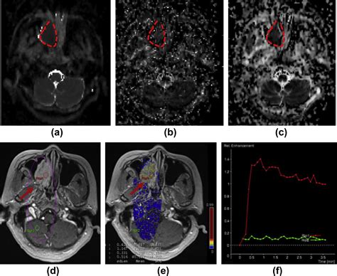 Intravoxel incoherent motion MRI for differentiating sinonasal small round cell malignant ...