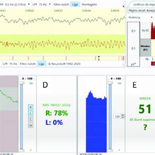 Pdf Multimodal Neuromonitoring During Pediatric Cardiac Surgery