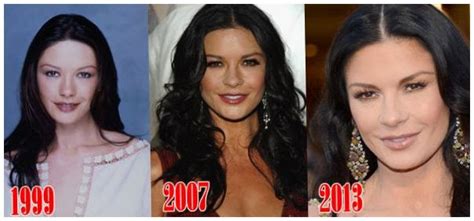 Blepharoplasty catherine Zeta Jones before and after photos ~ Celebrity ...