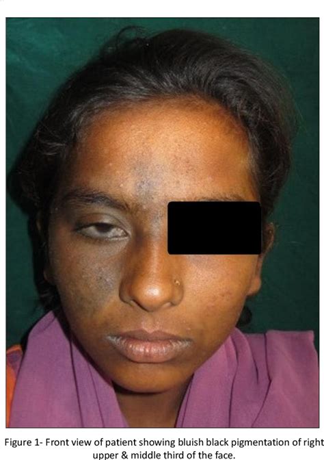 Figure 1 From A Nevus Of Ota With Intraoral Involvement A Rare Case