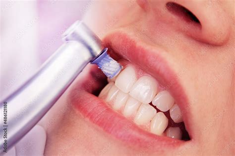 Conheça 3 benefícios da limpeza dental profissional Pérola Odontologia