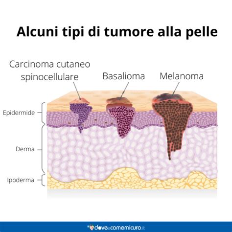 Carcinoma Basocellulare Il Basalioma Mortale Scopri Di Pi