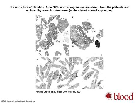 Newly Recognized Cellular Abnormalities In The Gray Platelet Syndrome