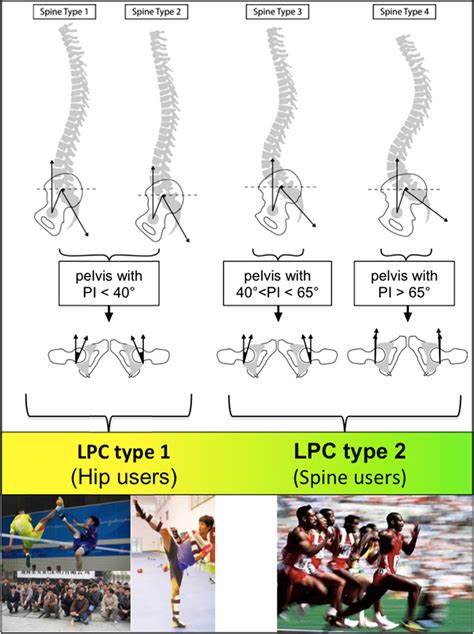 Classification Of Lumbo Pelvic Complex Lpc In Type 1 Stiff And Type