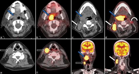 Imaging Of Extranodal Lymphomas In The Head And Neck A Case Series And Review Of The Literature