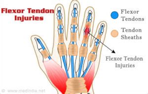 flexor tendon injuries handshoulder clinic