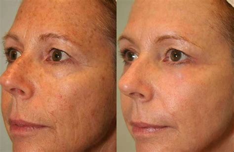 Co2 Laser Skin Resurfacing Phoenix Az Skin Care Of Arizona