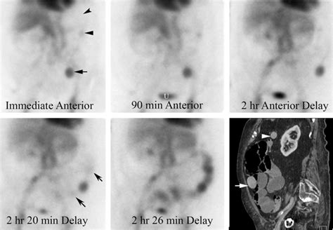 Nuclear Medicine Tests For Acute Gastrointestinal Conditions