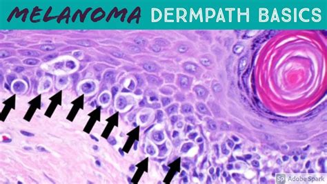 Jerad Gardner Md On Twitter How Do You Distinguish Melanoma Vs Nevus