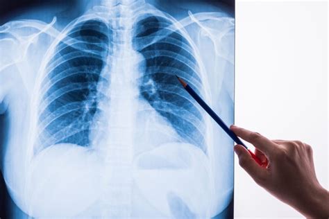 Pneumocystis Pneumonia Pcp