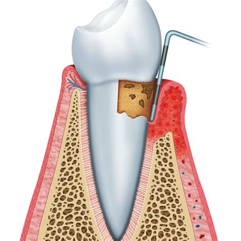 Lanap Near You In Temecula Ca Laser Periodontal Therapy