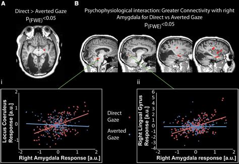 Amygdala Activation For Eye Contact Despite Complete Cortical Blindness