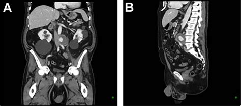 CT aortic angiography demonstrating a 47 × 46 × 47 mm infrarenal aortic ...