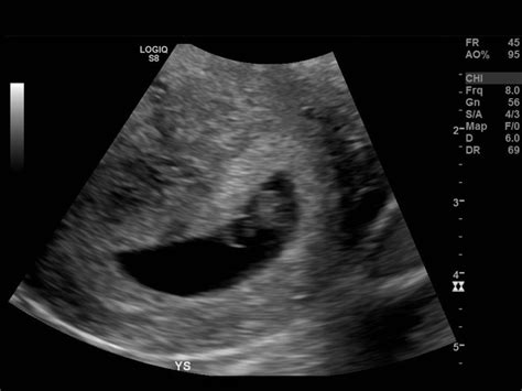 Early Pregnancy Ultrasound Dating – Telegraph