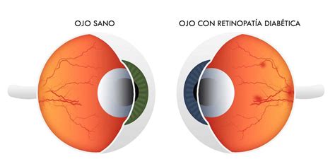 Retinopat A Diab Tica Visi N Oftalm Logos Monterrey M Xico