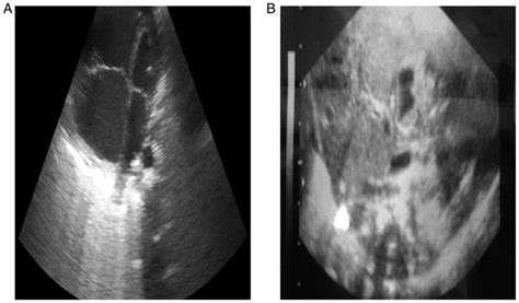 Pulmonary Hypoplasia Ultrasound