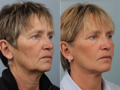 How Much Does A Deep Plane Facelift Cost Cosmetic Surgery Tips