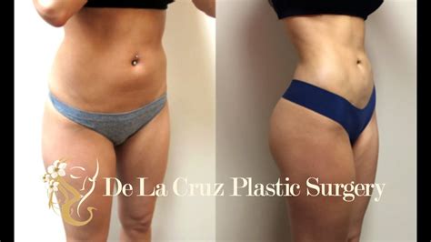 4d Vaser Hi Definition Liposuction Houston Texas By Emmanuel De La Cruz Md Pllc Youtube