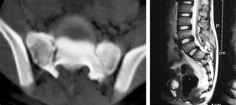 U Shaped Sacral Fracture An Easily Missed Fracture With High Morbidity A Report Of Two Cases